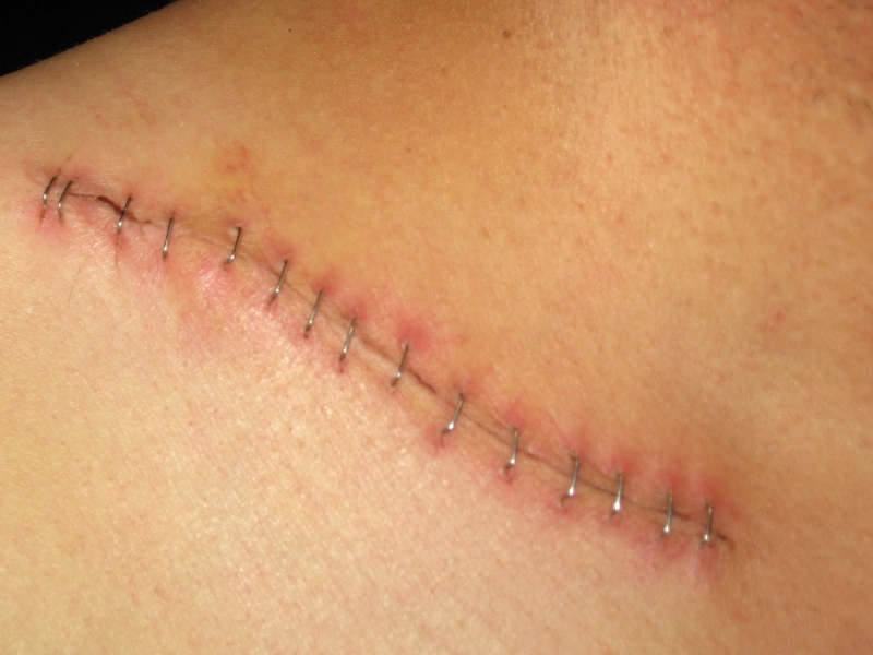 suture_my_shoulder__please_by_decarabia69